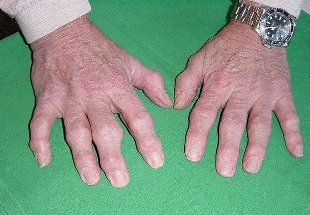 Osteoartrite dos dedos