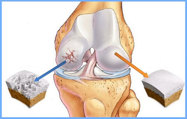 Articulação do joelho normal e afetada por artrose