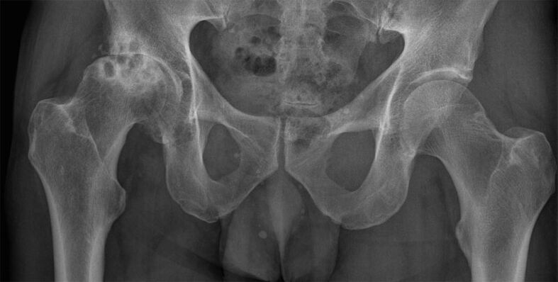 Artrose deformante da articulação do quadril no raio-x