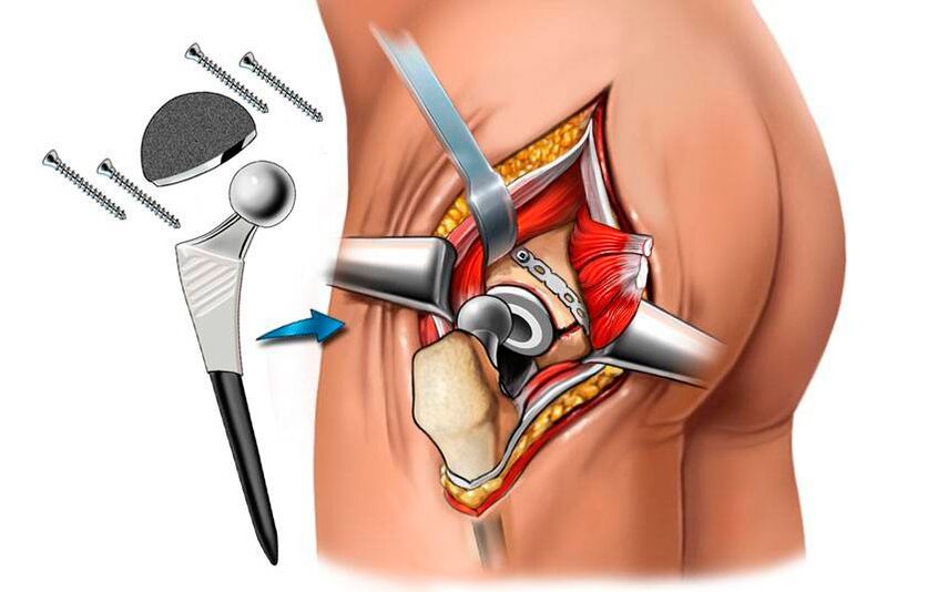Instalação de uma endoprótese - uma solução cirúrgica para o problema da coxartrose