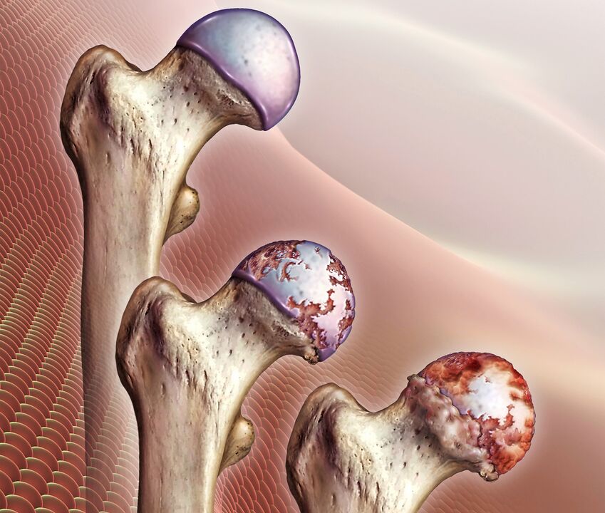 O desenvolvimento de artrose da articulação do quadril