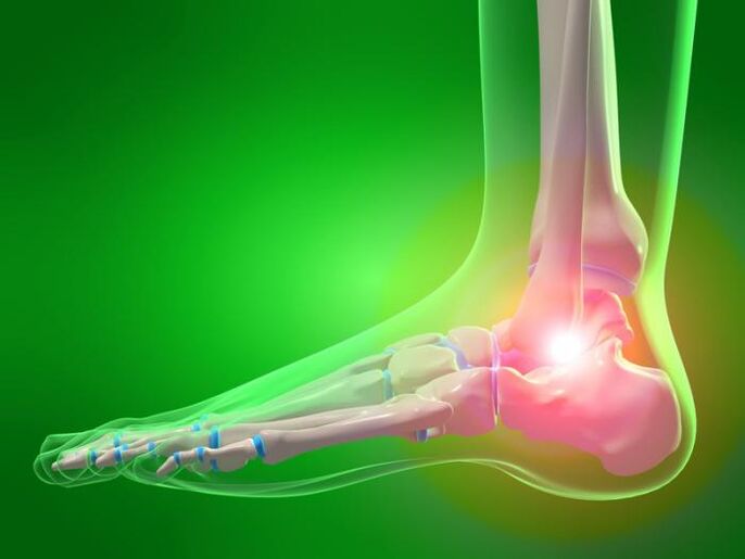 inflamação da articulação do tornozelo com artrose