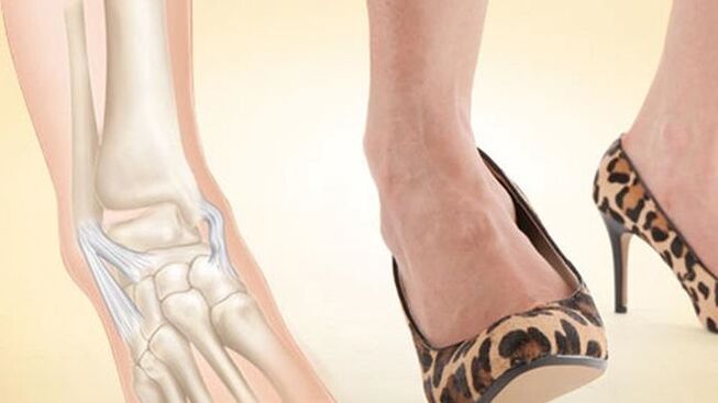 usar sapatos com saltos como causa de artrose do tornozelo