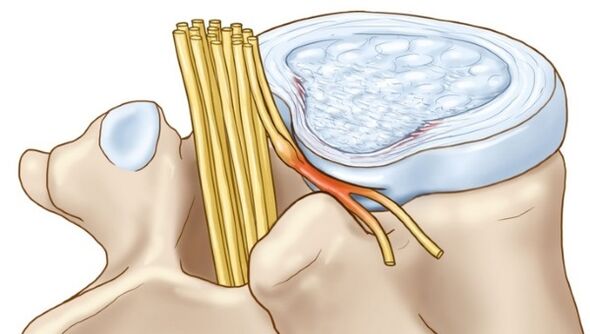 A osteocondrose lombar pode levar a complicações na forma de hérnia intervertebral