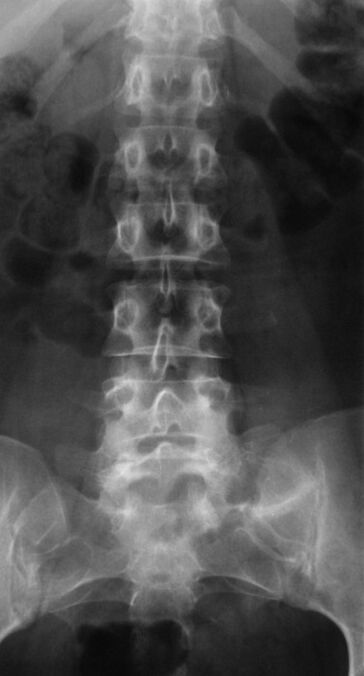 Para diagnosticar a osteocondrose lombar, é realizada radiografia