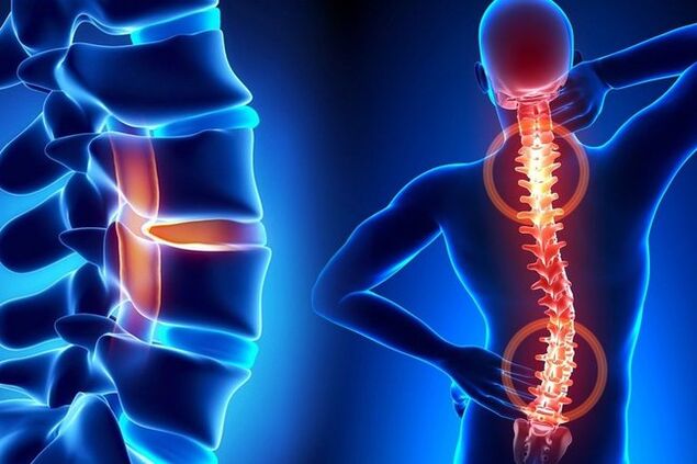 Osteocondrose da coluna