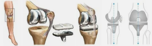 Artroplastia a exemplo do joelho